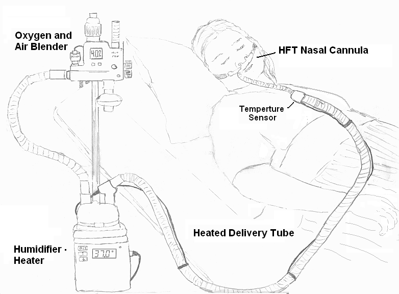 การรักษาด้วยอัตราการไหลสูง High Flow