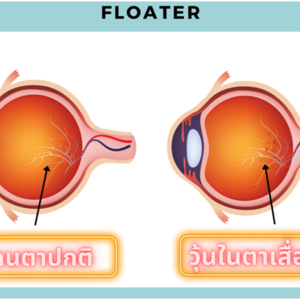 Floater (วุ้นตาเสื่อม)